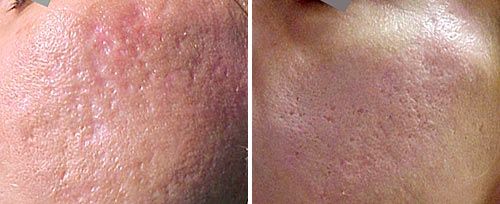 Acne Scars Treatment
