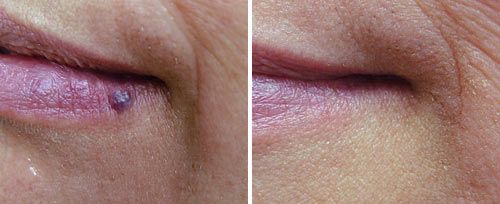 Hemangioma Treatment