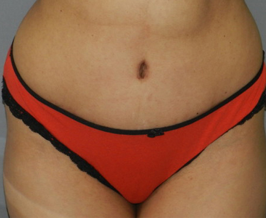 Newport Plastic-Body Contouring Result6