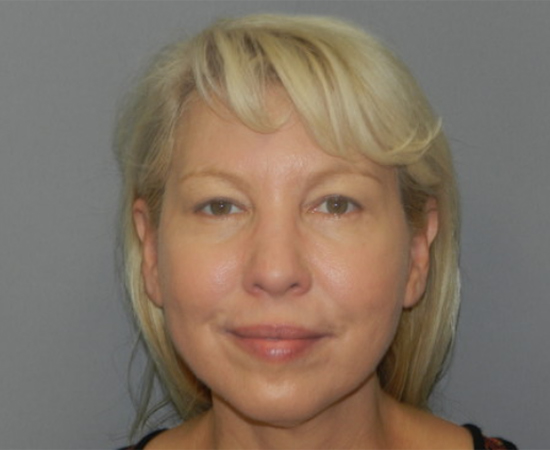Newport Plastic Surgery-Face surgery result2