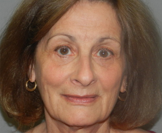 Newport Plastic Surgery-Face surgery result6