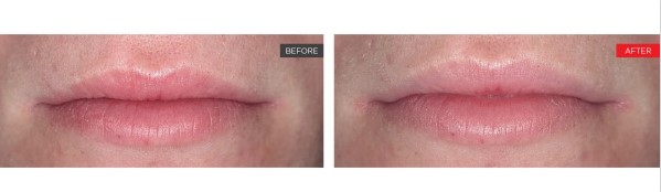 Newport-Plastic-Surgery-Lipase Result 2