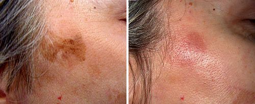 Pigmented-Lesions