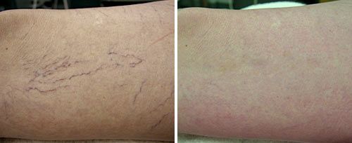 Spider Vein Removal