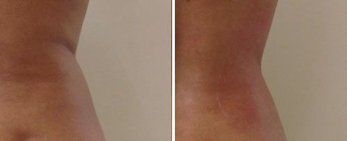 tightsculpting3