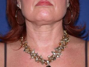 before neck liposuction female patient front view case 11904 Newport Beach, CA