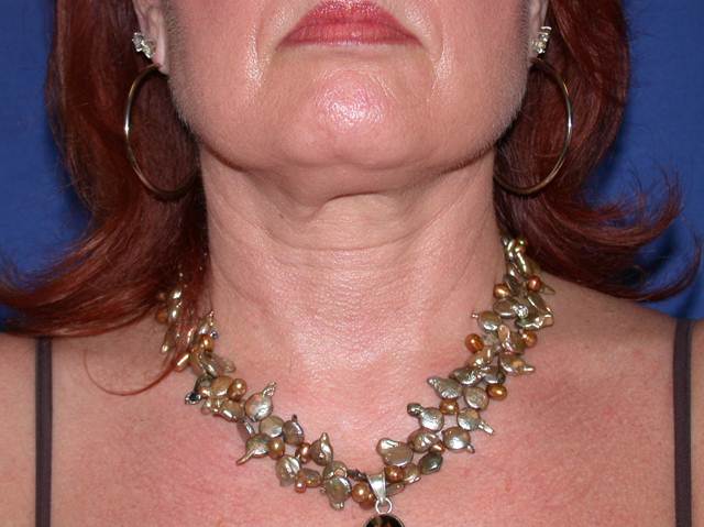 before neck liposuction female patient front view case 11904 Newport Beach, CA