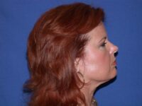 before neck liposuction female patient right side view case 11904 Newport Beach, CA