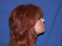 after neck liposuction female patient right side view case 11904 Newport Beach, CA