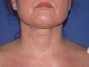 after neck liposuction female patient front view case 11904 Newport Beach, CA