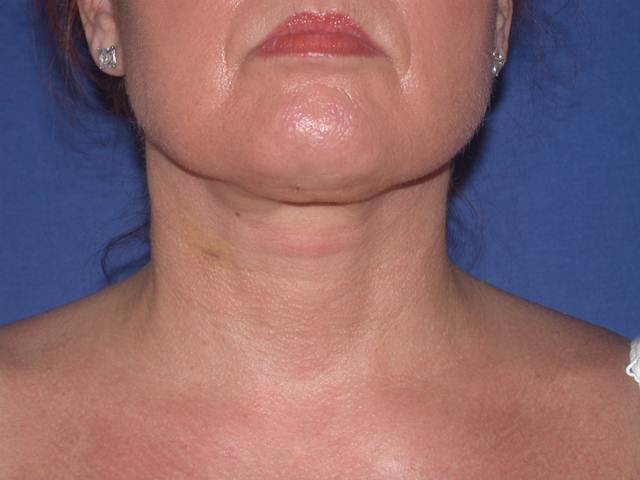 after neck liposuction female patient front view case 11904 Newport Beach, CA