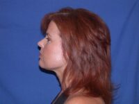 after neck liposuction female patient left side view case 11904 Newport Beach, CA