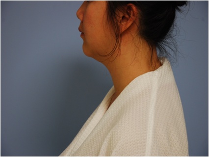 before neck liposuction female patient left side view case 11904 Newport Beach, CA