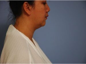before neck liposuction female patient right side view case 11904 Newport Beach, CA