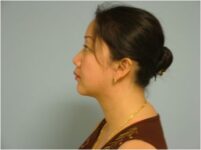 after neck liposuction female patient left side view case 11904 Newport Beach, CA