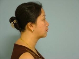 after neck liposuction female patient right side view case 11904 Newport Beach, CA
