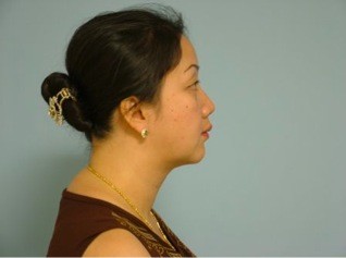 after neck liposuction female patient right side view case 11904 Newport Beach, CA