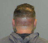 before neograft hair restoration male patient back view case 11904 Newport Beach, CA