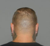 after neograft hair restoration male patient back view case 11904 Newport Beach, CA
