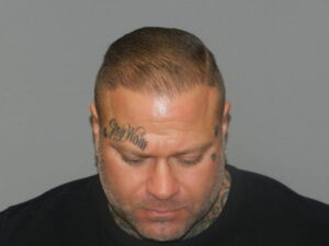 after neograft hair restoration male patient front view case 11904 Newport Beach, CA