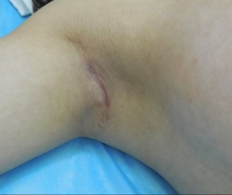 Right Transaxillary Incision