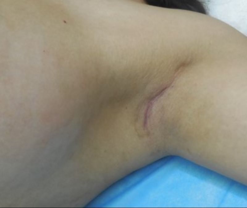 Left Transaxillary Incision